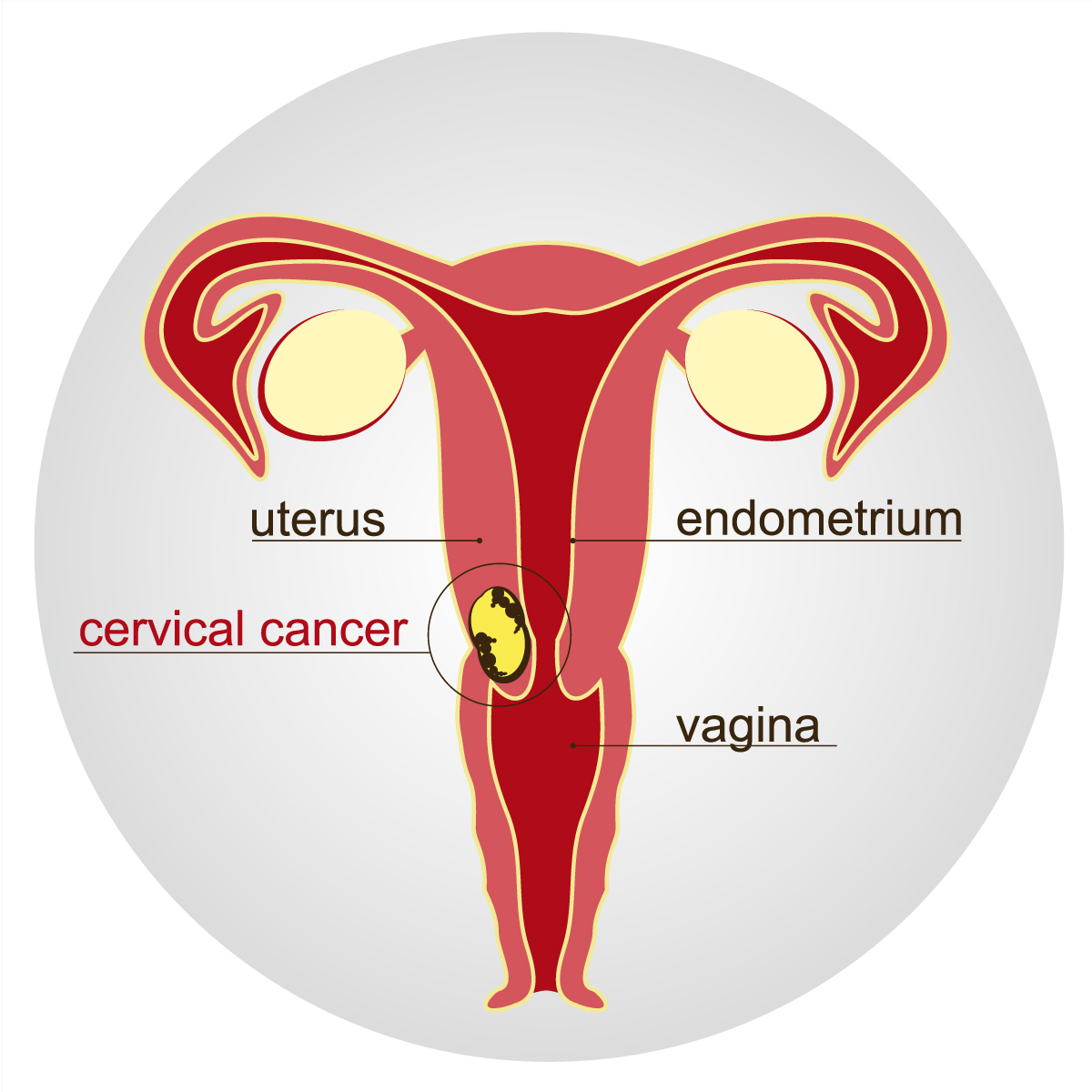 Cervical cancer